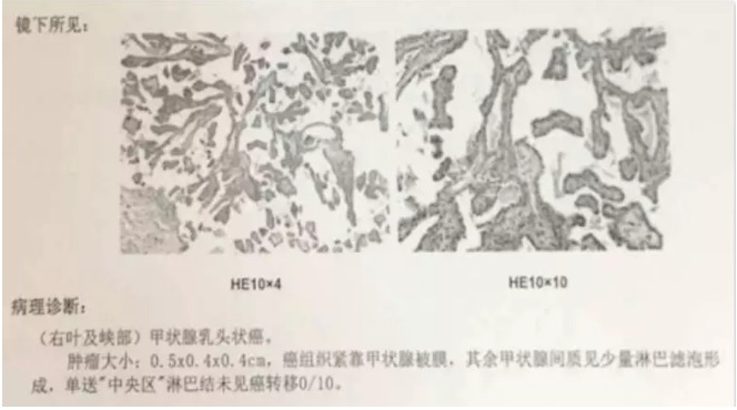 別慌，甲狀腺疾病還可以這樣投保！